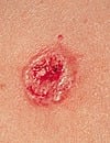 basal cell carcinoma